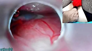 Japanese Insemination with Cum into Uterus and Endoscope Camera wits Cervix to watch inside womb Uncensored