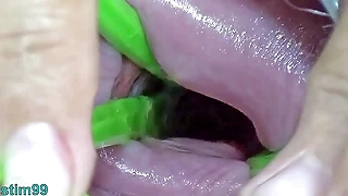 Cervix Dilatation